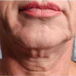 Sofwave Before & After Patient #1604